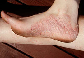  Health Tip: Caring for Psoriasis on Your Feet