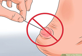 How to Treat a Burn Blister Caused by Friction and Burns   